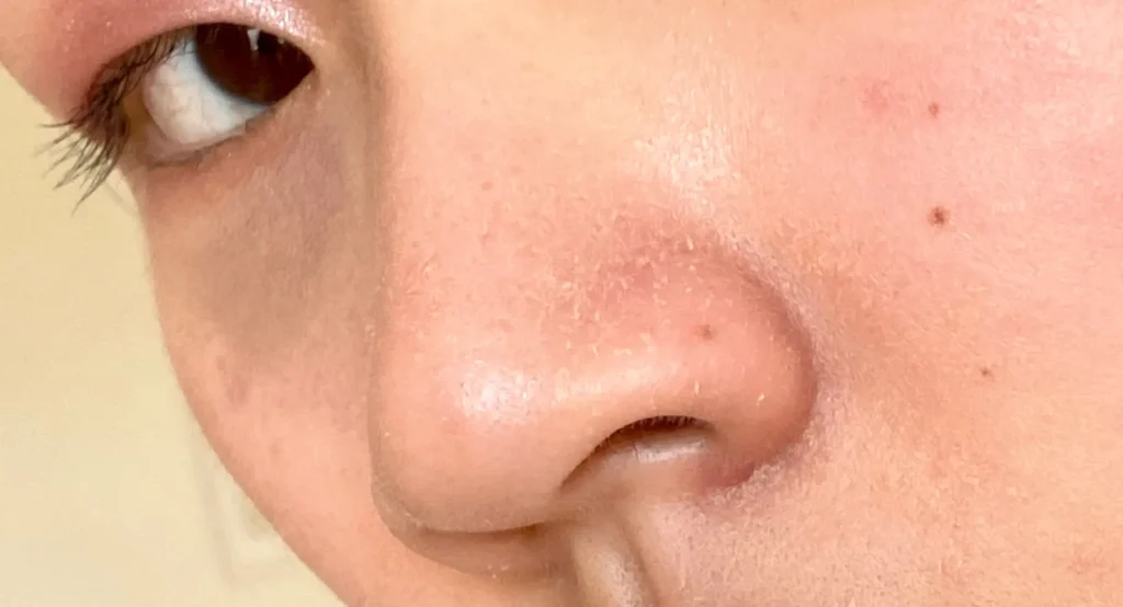 Your Skin Feels Dry, But Still Gets Oily